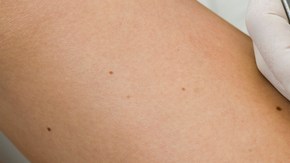 Un doctor remueve un melanoma (der.) de la piel  de un paciente con cáncer.