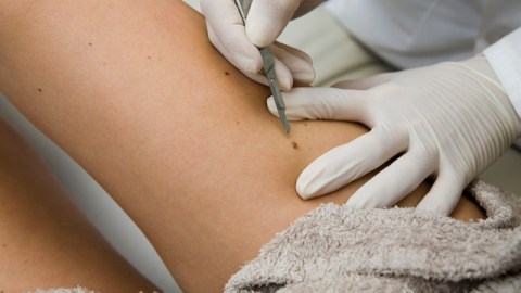 Un doctor remueve un melanoma (der.) de la piel de un paciente con cáncer.