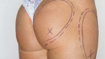 Según la acusación,   el médico usó un marcador para delinear las áreas afectadas de las pacientes.