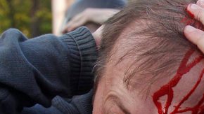 Un manifestante herido que protestaba contra la investidura de Vladimir Putin, en Moscú, Rusia.