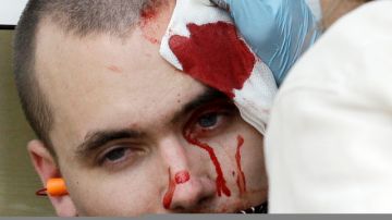 Un manifestante  con golpes en la cabeza.