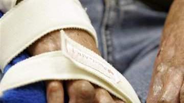 Un joven con quemaduras en las manos.