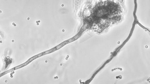 La meningitis es una infección cerebral que puede ser ocasionada por diferentes tipos de bacterias, virus u hongos.