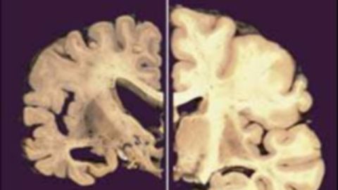 Una sección cruzada de un cerebro; la parte de la derecha está normal y la de la izquierda se encuentra con Alzheimer.