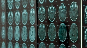 La revolucionaria técnica, denominada Clarity, consiste en un proceso químico  que pone transparente al cerebro sin alterar su forma ni conexiones.
