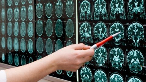 La revolucionaria técnica, denominada Clarity, consiste en un proceso químico  que pone transparente al cerebro sin alterar su forma ni conexiones.