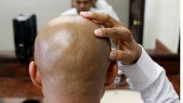La alopecia es una enfermedad genética.