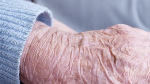 alzheimer