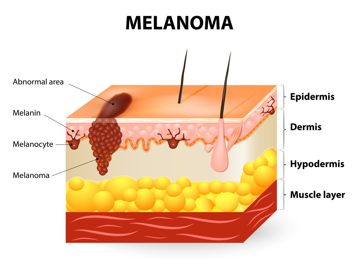 El melanoma se manifiesta, por lo general, por una lesión en la piel.