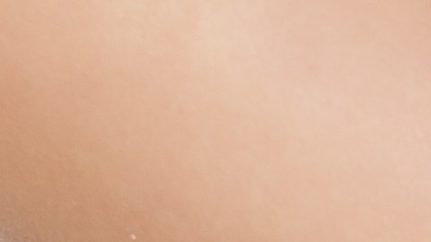 candidiasis