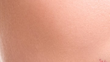 herpes