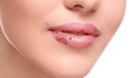 herpes