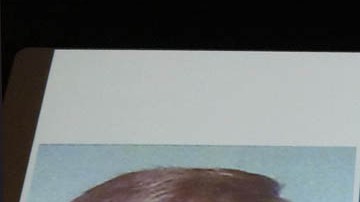 Patrick Hardison antes de sufrir la quemadura, luego con las heridas, y al final tras el trasplante.