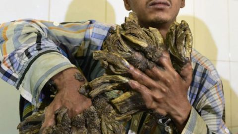 hombre arbol