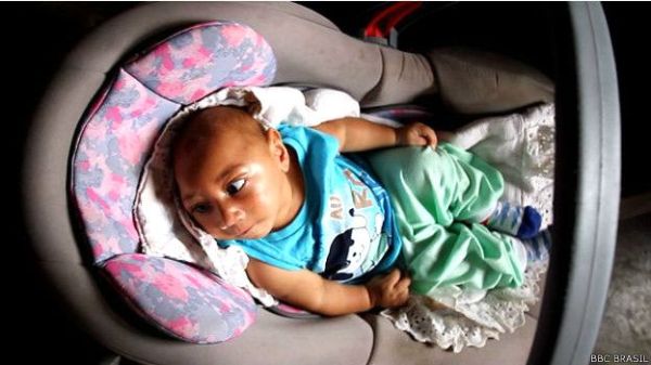 La historia del bebé con microcefalia conocido mundialmente por sus ...