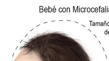 La microcefalia es un defecto congénito en donde la cabeza del bebé es más pequeña de lo esperado en comparación con la de los bebés de la misma edad y sexo.