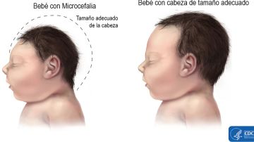 La microcefalia es un defecto congénito en donde la cabeza del bebé es más pequeña de lo esperado en comparación con la de los bebés de la misma edad y sexo.