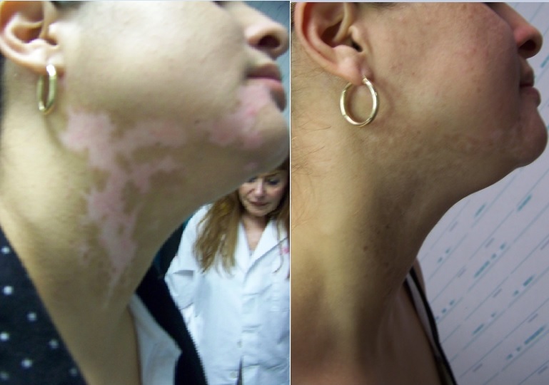 Miledys recibió el tratamiento de transplante de piel MKT luego de padecer vitíligo segmental.