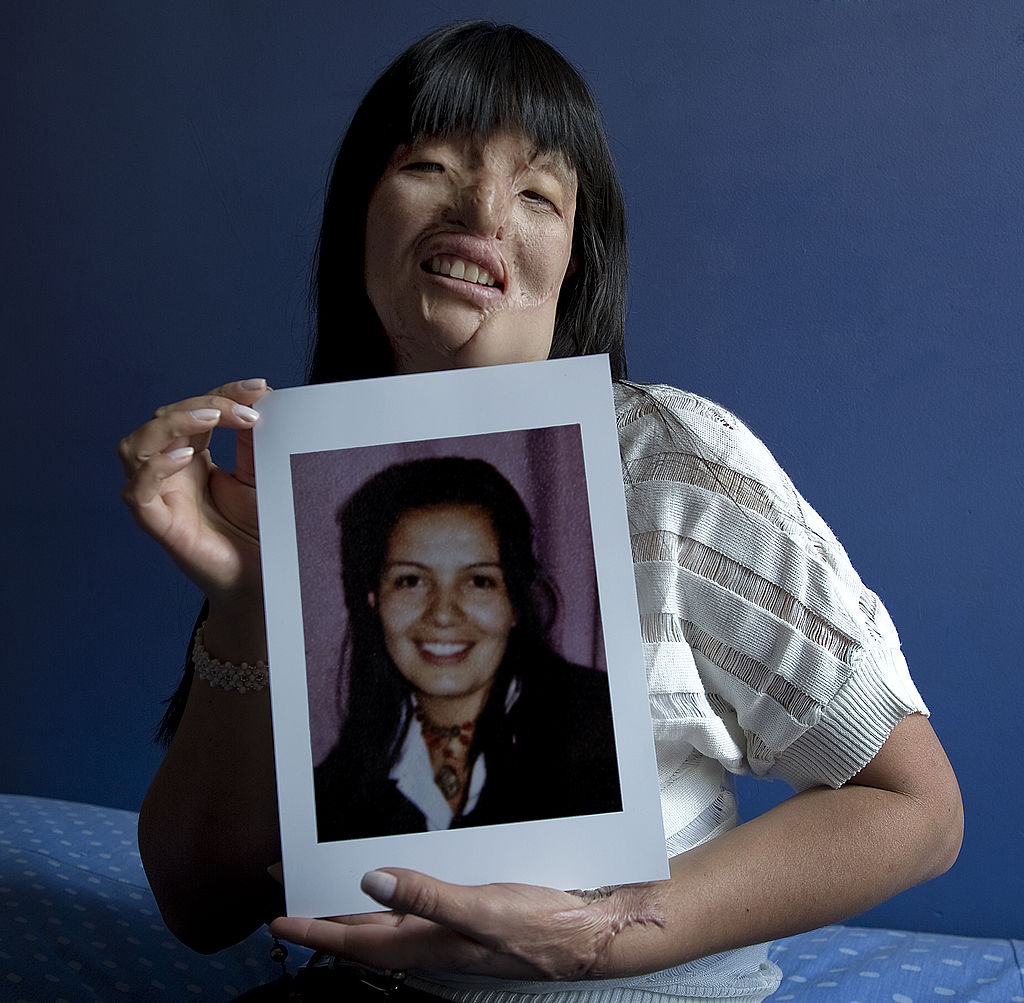 La colombiana Nubia Espitia posa junto a una foto suya antes del lamentable ataque. Espitia, de 37 años, fue atacada con ácido en 2008, y atribuye la agresión a una vesina envidiosa.