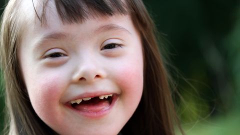 sindrome down