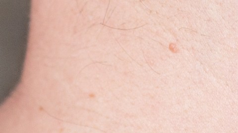 papiloma piel