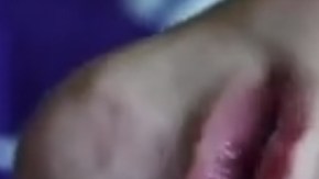 Un  bebé estadounidense nació con una malformación producto de una enfermedad congénita que hizo que su cerebro se desarrollara fuera de la cabeza.