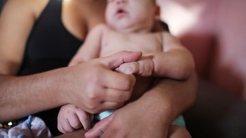 El virus del Zika se ha vinculado a los nacimientos de bebés con microcefalia.