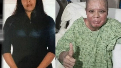 Martha Venegas, de 30 años, sufrió heridas de tercer grado en el 70 por ciento de su cuerpo.
