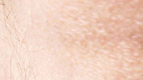 varices