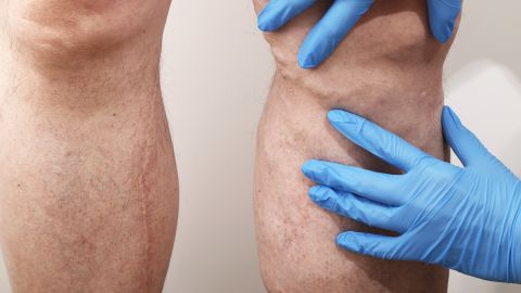 varices