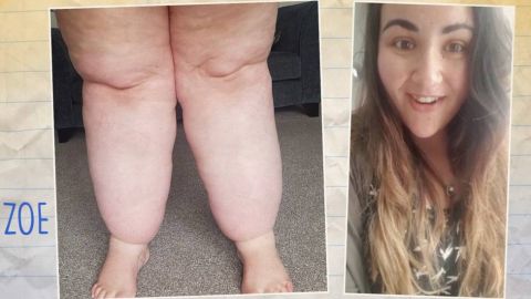 Aly se ha hecho liposucción dos veces sin ningún éxito