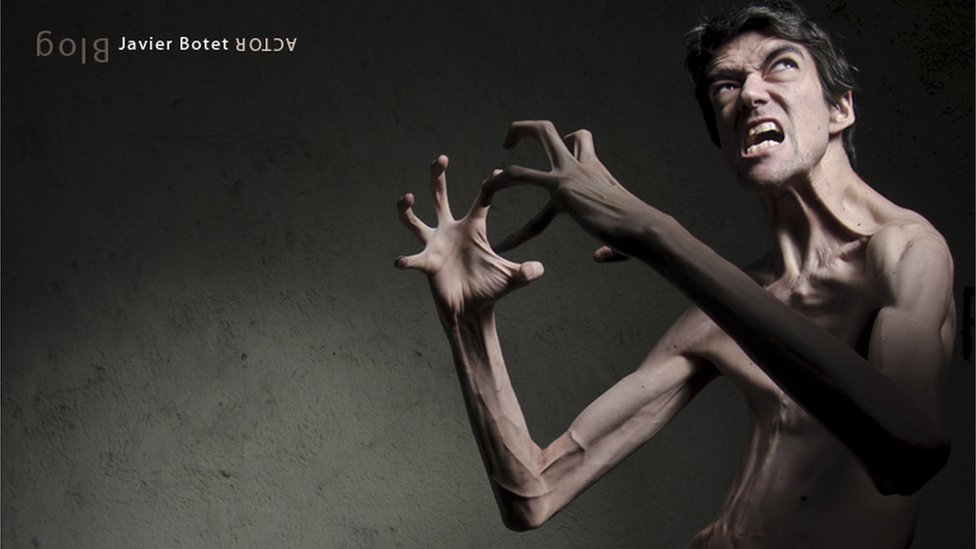 Síndrome de Marfan, la enfermedad que ayudó a un español a convertirse en un famoso actor