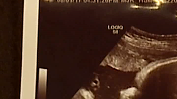 Alicia Zeek and Zac Smith esperaban una niña, pero en la ecografía vieron algo más.