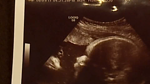 Alicia Zeek and Zac Smith esperaban una niña, pero en la ecografía vieron algo más.