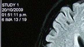 La zona del hipocampo es donde se almacenan los recuerdos.
