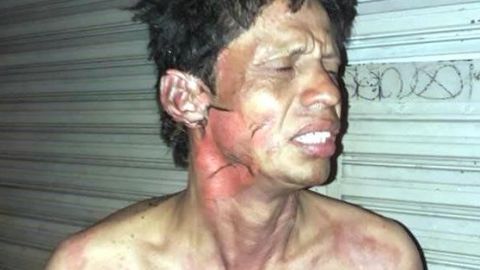 José Ramón Escobedo tuvo que ser atendido en el Hospital Rubén Leñero por las lesiones que las llamas le dejaron. Foto: Especial