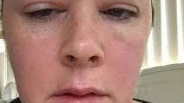 Amanda Coats tuvo una reacción alérgica a la micropigmentación de cejas.