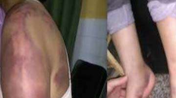 El hombre golpeó a su pareja en todo su cuerpo.