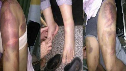 El hombre golpeó a su pareja en todo su cuerpo.