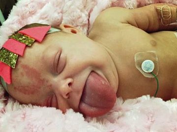 Paisley Morrison-Johnson, nación con el síndrome de Beckwith Wiedemann.