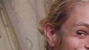 Zoey Tidwell tendrá que someterse a cirugía desde ahora hasta los 18 años cada seis meses.