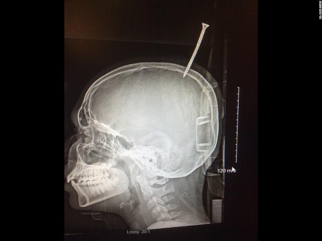 Un niño con un tornillo en el cerebro casi muere desangrado La Opinión