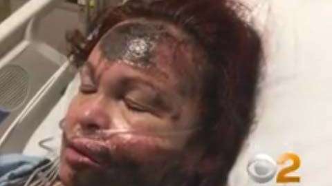 Se desconoce por qué la mujer se quemó el rostro.