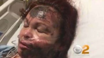 Se desconoce por qué la mujer se quemó el rostro.
