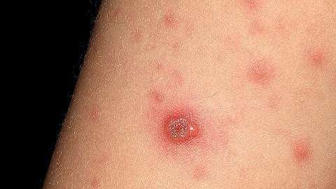 Luego del tercer o cuarto día de la infección, la persona desarrolla una erupción en casi todo el cuerpo.