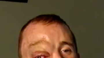 Lucas McCulley ha sido sometido a más de 25 operaciones para poder extirparle el tumor.