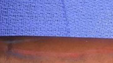 La primera cirugía de transplante con proceso de regeneración interna realizada por el cuerpo médico militar.