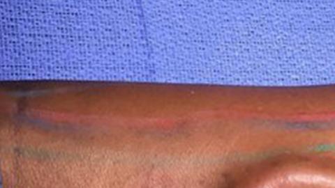 La primera cirugía de transplante con proceso de regeneración interna realizada por el cuerpo médico militar.