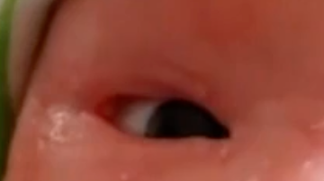 Bebé con la enfermedad congénita ictiosis del Arlequín.