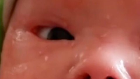 Bebé con la enfermedad congénita ictiosis del Arlequín.